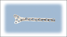 Condylar Buttress Plate Right/Left Leg 4.5mm