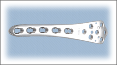 Distal Femur Locking plate (Right/Left Leg)